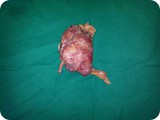Kidney Tumor